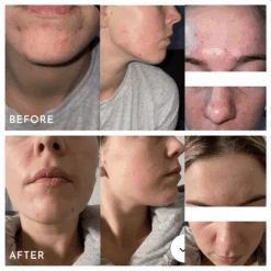 Extreme B17 -Skin Care Products Store AspectExtremeB17BeforeAndAfters b1a0cecd d7e1 4147 862c 3b14d68fbce8